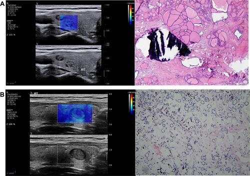 Figure 6 SWE images and HE staining of benign thyroid nodule. Imaging with SWE (A) shows blue as the hardest color, blue as the main color, no stiff rim, homogeneity of the internal color, and the color between the nodules and its surrounding. The SWE score was 0. HE histopathological staining (magnification, 40x). Nodular goiter: Follicles vary in size and are nodular. Imaging with SWE (B) shows green as the hardest color, blue as the main color, no stiff rim, inhomogeneity of the internal color, and the color between the nodules and its surrounding. The SWE score was 1. HE histopathological staining (magnification, 100x). Adenomatous goiter: a single nodule with a capsule visible on the surface. The follicles in the capsule are relatively uniform in size, showing adenoma-like hyperplasia.