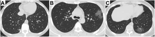 Figure 2 Chest CT images of two non-pregnant women with COVID-19 pneumonia. (A) 36-year-old female presenting fever and cough for 4 days. Only single focal ground-glass opacity (GGO) with consolidation was detected in the right lower lobe peripherally at presentation. (B, C) 34-year-old female presenting fever for 5 days. Multifocal pure GGOs with intralesional vessel enlargement were identified in the left upper and lower lobes with peripheral distribution.