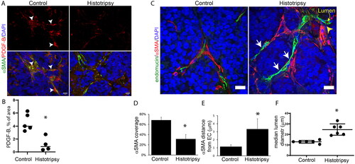 Figure 4. Histotripsy reduces pericyte coverage and induces vasodilation in NGP xenografts 24 h after treatment. A) Representative images of the VEGF target and pericyte recruitment ligand PDGF-B (red, arrowheads), lower in histrotripsy-treated tumors than controls. B) Quantification of PDGF-B ligand stains depicts lower PDGF-B levels as a result of histotripsy (p < 0.05, n = 4). C) Z-stacks captured with confocal microscopy shown as a 2D projection of the endothelial marker endomucin (green), the pericyte marker α-SMA (red) and nuclear DAPI stain (blue). Endothelial cells of untreated control tumors have a continual coverage of α-SMA pericytes lining (left panel). In contrast, histotripsy resulted in endothelial cells (green) lacking pericyte coverage (red), as well as higher separation between remaining pericytes and endothelial cells (yellow arrowhead). Scale bar: 10 µm. D) Quantification shows decreased endothelial cells (green) surrounded by neighboring α-SMA positive pericytes (red), p = 0.001). E) Pericytes distance from endothelium increases 3-fold after histotripsy (p < 0.01). F) Median vascular lumen of histrotripsy-treated tumors was two-fold wider than untreated controls, p < 0.01). *=p < 0.05. Graphs D and E represent means and standard deviation, B and F represent medians.