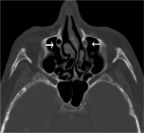 Figure 2 Axial image illustrating an opacified (small arrow) and a partially aerated (large arrow) nasal lacrimal duct.