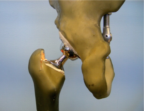 Figure 2. Composite model femur with a Prodigy stem and a 32 mm head. The center of the femoral head is in alignment with the tip of the greater trochanter
