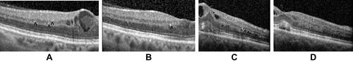 Figure 6 Hyper-reflective spots (HRS) in the inner nuclear layer (INL) and in the outer plexiform layer (OPL) are seen more prominently in the OCT before the dexamethasone implant. Magnification of Group 1 (A and B) and Group 2 (C and D) OCT pictures.