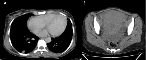Figure 1 The abdominopelvic CT with lower lung included showing bilateral basal lung patchy opacities with septic emboli (A) and Enlarged uterus with endometrial collection-suggestive of endometritis with sub involution of the uterus with small ascites (B).