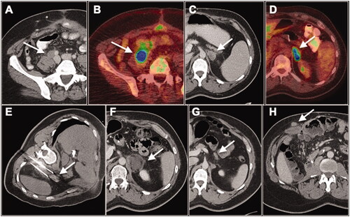 Figure 1. 48-year-old male with extrahepatic, extrapulmonary oligometastatic colorectal cancer treated with multidisciplinary approach over several years. (A, C) Axial contrast-enhanced CT and (B, D) 18F-FDG PET/CT show large, FDG-avid (A, B) right common iliac lymph node (white arrows) and (C,D) left adrenal metastases (white arrows). Patient was started on immunotherapy with excellent response for the right common iliac lymph node metastasis but not for the left adrenal metastasis (not shown). (E) Patient subsequently underwent CT-guided cryoablation of the left adrenal metastasis (white arrow). Follow-up CT at (F) 3 months and (G) 5 years post ablation demonstrates evolution of the ablation zone with no recurrent disease in the left adrenal gland at long-term follow-up (white arrow). (H) During the 5-year follow-up period, the patient also developed a subcutaneous metastasis in the right abdominal wall which was surgically resected (white arrow). He is currently without evidence of disease.