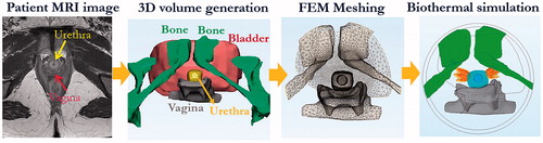 Figure 3. Patient-specific model generation and simulation workflow, shown in the sequential order of MRI image segmentation, 3D volume generation, FEM meshing, and numerical acoustic and biothermal simulation to calculate transient temperature elevations and thermal dose accumulation (dose volumes of 60 EM43 °C and 240 EM43 °C are shown in yellow and orange, respectively).
