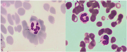 Figure 1 Howell-Jolly body-like inclusions found in neutrophil (arrow sign).