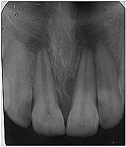 Figure 1 Preoperative radiograph with periapical radiolucencies # 51 and 61.