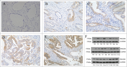 Figure 1. PHGDH was upregulated in cervical adenocarcinoma tissues. (A) Negative PHGDH staining in normal cervical glandular epithelium. (B and C) Negative/weak staining of PHGDH in cervical adenocarcinoma tissues. (D and E) Moderate/strong staining of PHGDH in cervical adenocarcinoma tissues. (F) Western blot analysis showed PHGDH expression was higher in cervical adenocarcinoma tissues than that in normal cervical epithelium cells relative to the loading control (Glyceraldehyde 3-phosphate dehydrogenase).