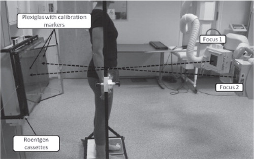 Figure 17. The RSA setup. Two angulated x-ray tubes, focus 1 and 2. The patient is placed where the x-ray beams cross each other. The x-ray films and calibration cage are located behind the patient.