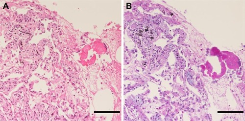 Figure 4 Pathological findings in biopsy specimens. Thickness of the alveolar walls with myxofibrous and lymphocytic infiltration changes. Agglutination of red blood cells with focal coagulate change was observed in the air spaces of the alveoli (H&E staining) (A). Thickening of the alveolar walls with focal myxomatous early fibrous change was seen (Alcian Blue–Periodic Acid Schiff staining) (B). Scale bars, 100 μm.