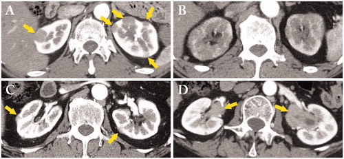 Figure 1. A variety of contrast-enhanced computed tomography (CT) findings in IgG4-related kidney disease. (A) Multiple low-density lesions in the bilateral kidneys (arrows); (B) Diffuse patchy involvement of the bilateral kidneys; (C) Rim-like lesion of the kidney (arrows); (D) Renal pelvis thickening with smooth intraluminal surface (arrows).