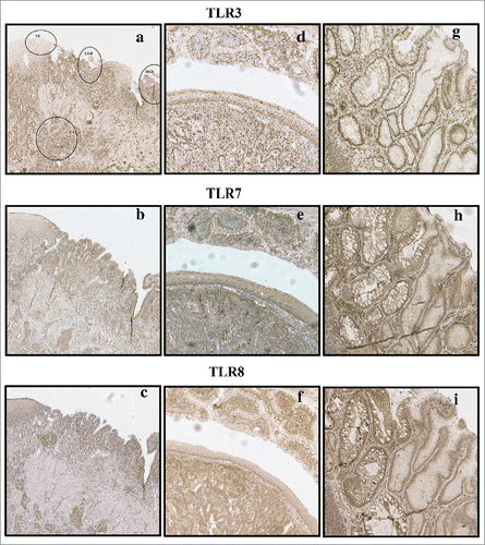 Figure 1. Examples of typical expression patterns of TLR3, TLR7 and TLR8. (A)–(C) representing the same sample with normal epithelium (NE), low-grade dysplasia (LGD), high grade dysplasia (HGD) and adenocarcinoma (CA) marked in (A). Gradual increase is found through normal epithelium–metaplasia–dysplasia sequence. (D)–(F) show intestinal type metaplasia (top), normal epithelium (middle) and adenocarcinoma (bottom). Intestinal metaplasia in TLR3, 7 show basal polarization, whereas TLR8 is expressed more diffusely. Expression pattern of all studied TLRs in adenocarcinoma is diffuse extending homogenously throughout the cell cytoplasm with no apparent basal polarization. (G)–(I) show intestinal metaplasia (left) and gastric type metaplasia (right). Gastric metaplasia presented a strong polarized staining to the basal cytoplasm in all studied TLRs. Magnifications 6× and 20× were used.