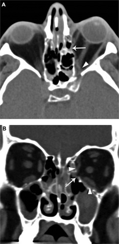 Figure 2 Computed tomography (CT) images of the orbits from Case 1. (A) Axial and (B) coronal CT images show bony dehiscence in the medial wall of the left orbit (arrows).