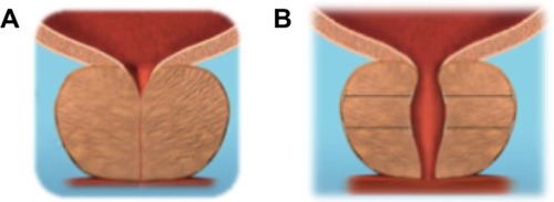 Figure 1 Applying a tissue retracting implant between the urethra and the prostatic capsule lifts the urethra toward the capsule thereby expanding the urethral lumen.