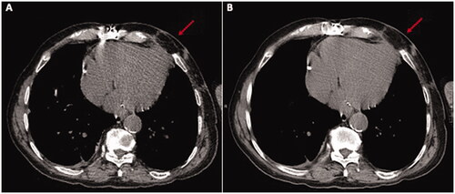 Figure 4. A CT scan executed 1 month post-op (A) and 1 year post-op (B) clearly shows the trophism of the flap (red arrow) and no collection.