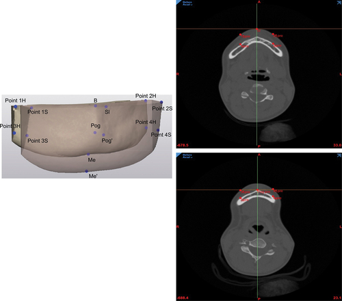 Figure 2. Three-D landmarks on the chin surface. To the left, 14 reproducible landmarks were plotted on the surface of the 3-D chin to perform the measurements. Six points on the midsagittal plane: Point B, hard tissue pogonion (Pog), hard tissue menton (Me), sublabial (Sl), soft tissue pogonion (Pog’), and soft tissue menton (Me’). Eight points were plotted on the right and left lateral sides of the hard and soft tissue chin surface: points 1H and 1S, points 2H and 2S, points 3H and 3S, and points 4H and 4S. To the right axial view of the points.