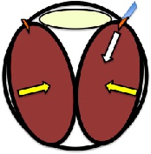 Figure 1 This illustration shows that the tip of the trocar retracted into the suprachoroidal space.