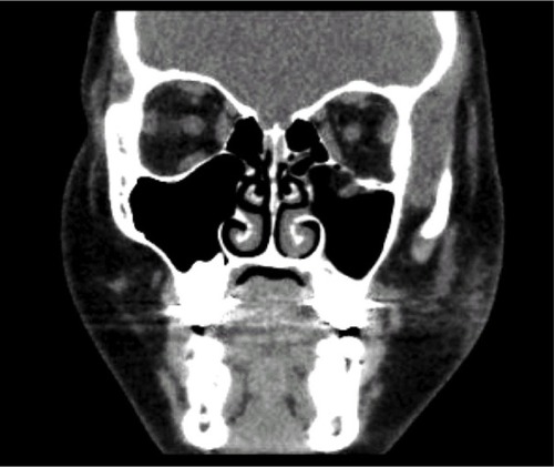 Figure 1 Coronal CT imaging of a pediatric patient with a left orbital floor greenstick fracture.
