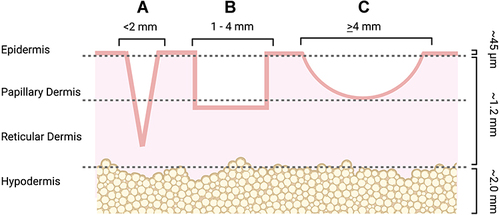 Figure 1 Visual representation of atrophic acne scar subtypes.