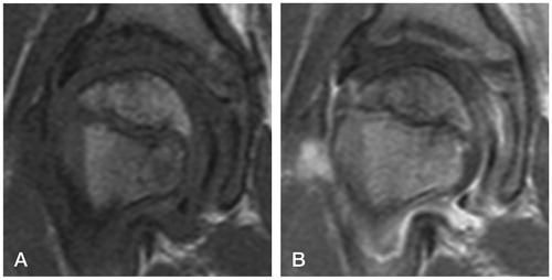 Figure 1. At 6 weeks. MRI (A) and contrast MRI (B). Prior to stage Ia.