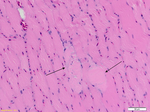 Figure 7. Rock dove, pectoral muscle: Scattered myofibers show acute degeneration and necrosis (arrows), characterized by myofiber swelling, cytoplasmic vacuolation, eosinophilia and loss of striations, basophilic inclusions (interpreted as early mineralization), and pyknosis.
