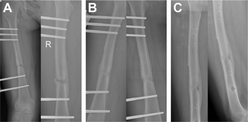Figure 2 X-ray images of femoral fracture treated by external fixation and PABMT. A 12-year-old girl sustained a femoral shaft fracture in a traffic accident and was treated with external fixation. The frontal and lateral X-ray films showed clear fracture line with a small amount of callus 4 months after fixation. The girl was included in this study, and autologous bone marrow was injected to the delayed union site (A). One month later, there were obvious bony calluses, but the fracture line was visible (B). In the next 2 months, the patient underwent bone healing, and the external fixator was removed (C).
