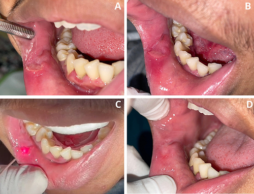 Figure 4 A 16-year-old man with TUGSE. (A) Ulcer on the right labial mucosa (B) Ulcer condition at the second visit (day 7) (C) Application of PBM to ulcers. (D) The fourth visit (day 21): ulcer lesion showed an improvement.