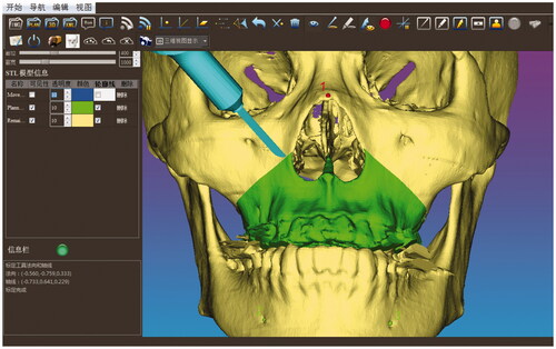 Figure 3. The position and orientation of the surgical saw were tracked in real time and displayed on the computer screen so that the maxilla was resected according to the preoperative planned trajectory.