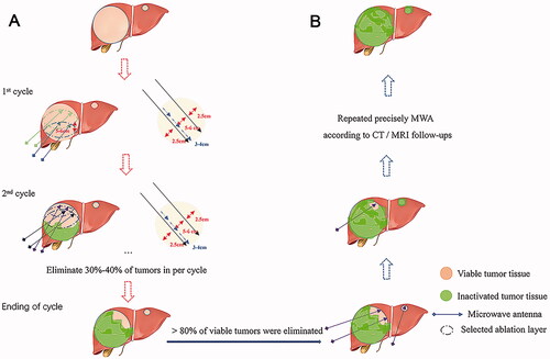 Figure 2. Step-by-step debulking MWA. The MWA procedure for huge HCC can be divided into two stages: the heavy ablation stage (A) and residual tumor ablation stage (B). HCC: Hepatocellular carcinoma; TACE: transarterial chemoembolization; MWA: microwave ablation.