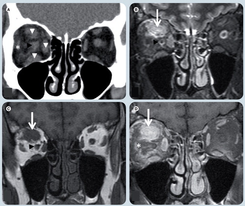 Figure 8. Orbital pseudotumor.(A) Coronal noncontrast soft tissue window CT image, (B) T2-weighted image (WI), (C) T1-WI and (D) T1-weighted fat-suppressed postgadolinium MR images. There is enlargement of the superior, medial and inferior rectus muscles (white arrowheads) more prominent in the superior one which shows an area of (B) T2 hyperintensity and (C) T1-WI isointensity relative to signal intensity of muscle and a poorly-defined area (white arrows) in its center. The ‘dirty fat’ sign is secondary to inflammatory changes in the intraconal fat (white asterisk). The optic nerve (black arrowheads) is shifted, but otherwise normal. The left orbit is unremarkable.