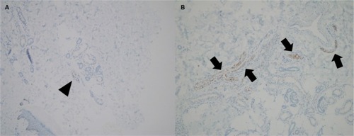 Figure 3 Microscopic findings of immunohistochemistry for neurofilament protein show more axons (arrowhead and arrows) in lesion site (B) than normal skin (A); (hematoxylin and eosin stain 100×).