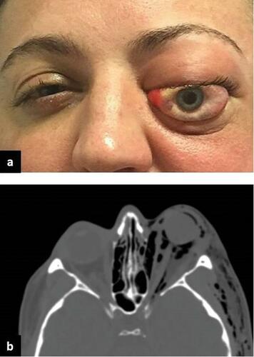 Figure 1 (A, B) A patient with left orbital compartment syndrome secondary to orbital emphysema (a). Axial CT image at the level of the optic nerve demonstrating intraorbital and subcutaneous emphysema.