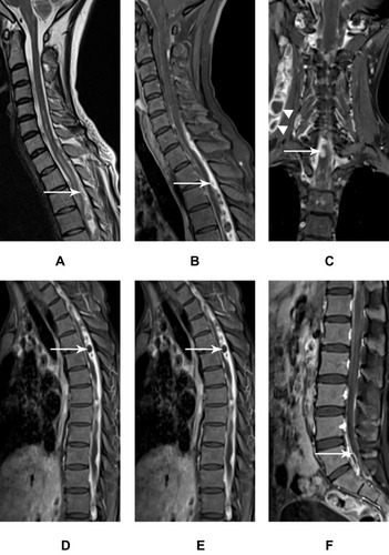 Figure 2 Multiple intraspinal tuberculomas companied with thickened meninges in the cervical, thoracic, and lumbar segment.Notes: Intraspinal extramedullary tuberculomas in a 25–year–old female. Sagittal T2WI (A, D) shows a slight hyperintensity of the tuberculomas (white arrow) and diffuse edema of the spinal cord. Gadolinium contrast MR images (B–C, E–F) show tuberculomas with both homogeneous (C, white arrow) and ring (E, white arrow) enhancement that integrate with adjacent irregularly thickened meninges. Cervical lymph nodes are enlarged and exhibit ring enhanced (C, white arrowhead).Abbreviations: T2WI, T2-weighted imaging; MR, magnetic resonance.