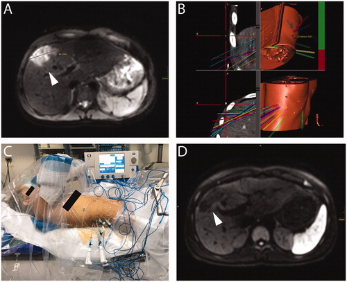 Figure 2. A 15-year-old patient with hepatic subcapsular cyst (Echinococcus multilocularis). (A) A 5.2 × 4.4 cm E. multilocularis lesion (white arrow). (B) Multiple probe trajectories (colored lines) are defined by using multiplanar and 3D reconstructed images before the ablation procedure. (C) SRFA electrodes are sequentially introduced into the coaxial needles. (D) MRI image 3 months after SRFA (white arrowhead) depicts scar tissue without evidence of cystic lesions.
