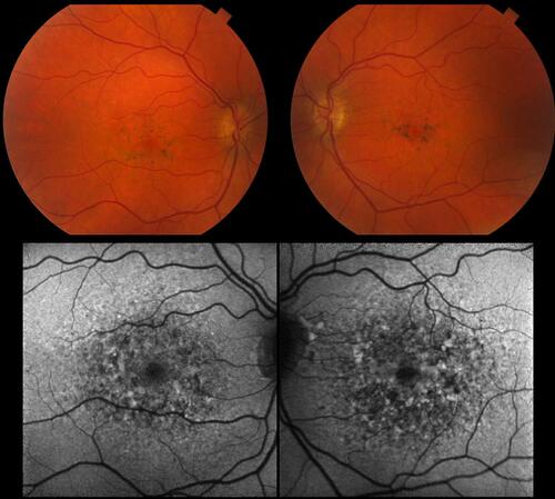 Figure 1 (Patient 9) Fundus photography: Fundus autofluorescence at early stage of disease showing pigment mottling, reticular hypoautofluorescent and hyperautofluorescent spots, and focal areas of RPE enlargement.