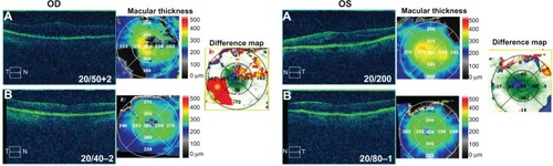 Figure 5 Optical coherence tomography studies for case 5 (uveitis).