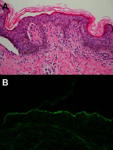 Figure 7 (A) Subepidermal blistering with predominance of neutrophils in the upper dermis concentrated on the dermal papillae (H&E, 400×). (B) Direct immunofluorescence on NaCl-spit skin shows immunoglobulins G in a linear and granular pattern along the base of the blister cavity (400×).