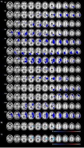 Figure 3. (A) Lesion map for individual patients. B-C) Lesion overlap map summarising the degree of involvement for each voxel in the intervention (B; N = 8) and control (C; N = 5) groups. Lesions were identified by a clinical neurologist (K.M.), who was blind to the design, group assignment and purpose of the study. Lesions were mapped onto 11 axial slices of a T1-weighted template, corresponding to the MNI z coordinates of −24, −16, −8, 0, 8, 16, 24, 32, 40, 50, 60 mm using identical or closest matching transverse slices for each patient using MRIcro software package (Rorden & Brett, Citation2000). Due to technical difficulties at the clinical facility, we were able to obtain and map digital brain scans for 13 patients only (6 MRIs and 7 CTs) as the remaining digital brain scans were either lost or corrupted. Please note however, that all brain scan reports were available and confirmed the presence of a stroke and its location for all our patients. The range of colour scale derives from the absolute number of patient lesions involved in each voxel.