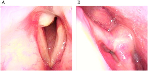 Figure 3. Endoscopic imaging findings 2 weeks after the initial visit. (A) No oedema or redness is on the bilateral vocal cords. Necrotic tissue is slightly visible in the posterior glottic region. (B) The right vocal cord has active mobility on phonation.