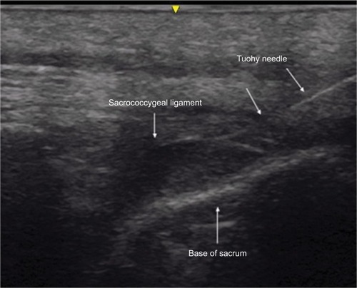 Figure 3 Longitudinal image of the sacrum showing the advancement of the Tuohy needle toward the sacrococcygeal ligament.