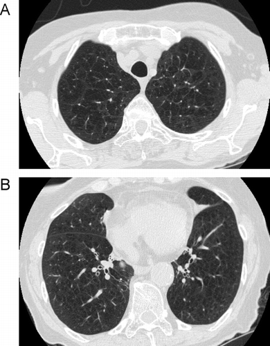 Figure 13 Centrilobular emphysema. (A) a CT through the upper lobes shows multiple poorly defined “black holes”, some of which contain a central vessel, indicating centrilobular emphysema. (B) a similar pattern is seen in the lower lobes of the same patient.