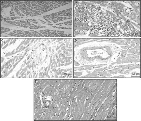 Figure 8. Representative photomicrographs of myocardial sections stained with H&E from different experimental groups. (A) Healthy control rats showing normal architecture of myocardium; (B) ISP-treated control rats, showing severe myocardial damage with excessisive inflammatory cell infilteration; (C) HETA-treated rats, showing normal myocardium with less inflammation than in ISP-treated controls; (D) α-tocopherol-treated rats, showing improvement in myocardial architecture relative to ISP-treated controls; (E) HETA + α-tocopherol-treated rats, showing normal myocardium. Figures are representative of at least five separate experiments.