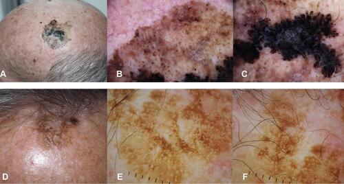 Figure 1 Lentigo maligna melanoma on the scalp of a 78-year old man with androgenic alopecia (A–C) and solar lentigo on the scalp of a 81-year old man. (D–F) (A) Clinical appearance of the LMM. A large macule, variegated in color from light to dark brown to black with ill defined borders. In the background, signs of extensive sun-damage. (B) Dermoscopy showing a brown pseudo network with grayish circles around follicular openings and white streaks. (C) Dermoscopy of the hyper pigmented part, with obliteration of follicular openings, blue white veil and irregular dots. (D) Clinical appearance of a solar lentigo: a brown macule with a hyperkeratotic component. (E and F) Dermoscopy showing a light brown pseudo network with evident follicular openings and cerebriform pattern.