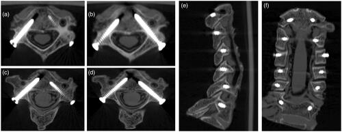 Figure 6. Postoperative CT scan showed positions of cervical pedicle screws with the assistance of one-level bilateral navigation template. (a and b) C4 pedicle screws classified as Grade 0 (axial plane). (c and d) C3 pedicle screws classified as Grade 0 (right) and Grade 1 (left) (axial plane). (e_ C2–C7 pedicle screws from sagittal plane. (f) C2–C7 pedicle screws from coronal plane.
