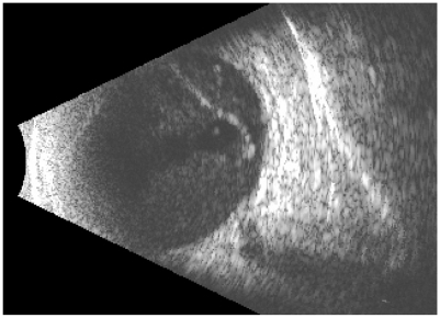 Figure 4 B-scan echography of the right eye showing vitreous opacities with membranes, typical of endophthalmitis.