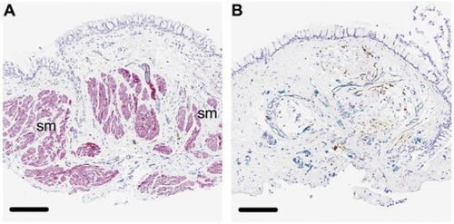 Figure 2 Structural effects of BT in bronchial biopsy specimens from patients with severe asthma.