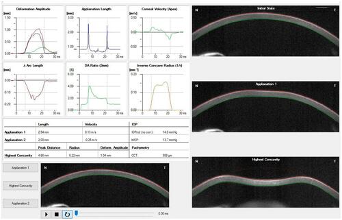 Figure 1 Example of a print-out from the Corvis ST® describing the corneal, shape within different timepoints and several biomechanical parameters.Notes : Copyright ©2021. Reproduced from Baptista PM, Marta AA, Marques JH, Abreu AC, Monteiro S, Menéres P, Pinto MDC. The Role of Corneal Biomechanics in the Assessment of Ectasia Susceptibility Before Laser Vision Correction. Clin Ophthalmol. 2021;15:745-758.Citation146