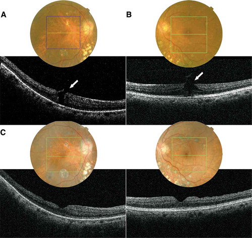 Figure 2. Optical coherence tomography images. (A) Stage 2 macular hole (arrow) in the right eye December 2007. (B) Stage 2 macular hole (arrow) in the left eye January 2013. (C) Bilateral macular holes were successfully closed after a combined vitrectomy/phacoemulsification, images taken in February 2013.
