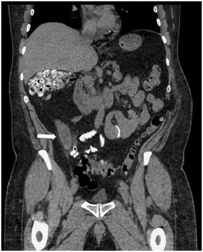 Figure 2. A computed tomography scan (coronal view) of a 63-year-old man who presented with signs and symptoms of acute appendicitis. The scan showed distended appendix (arrow). The patient underwent emergent appendectomy and pathological exam diagnosed mucinous appendiceal adenocarcinoma.