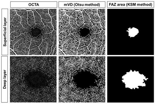 Figure 2 Optical coherence tomography angiography (OCTA) image (left), binarization image with the Otsu method for calculating the macular vessel density (mVD; middle), and the image obtained with the Kanno-Saitama Macro (KSM) method for calculating the foveal avascular zone (FAZ; right) area (upper, superficial layer; lower, deep layer).